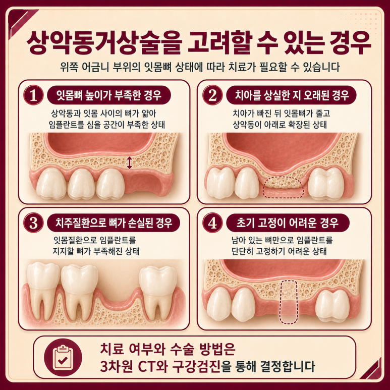 송정동치과 잇몸뼈가 부족하면 상악동거상술을 꼭 해야 할까요? 관련 이미지 4