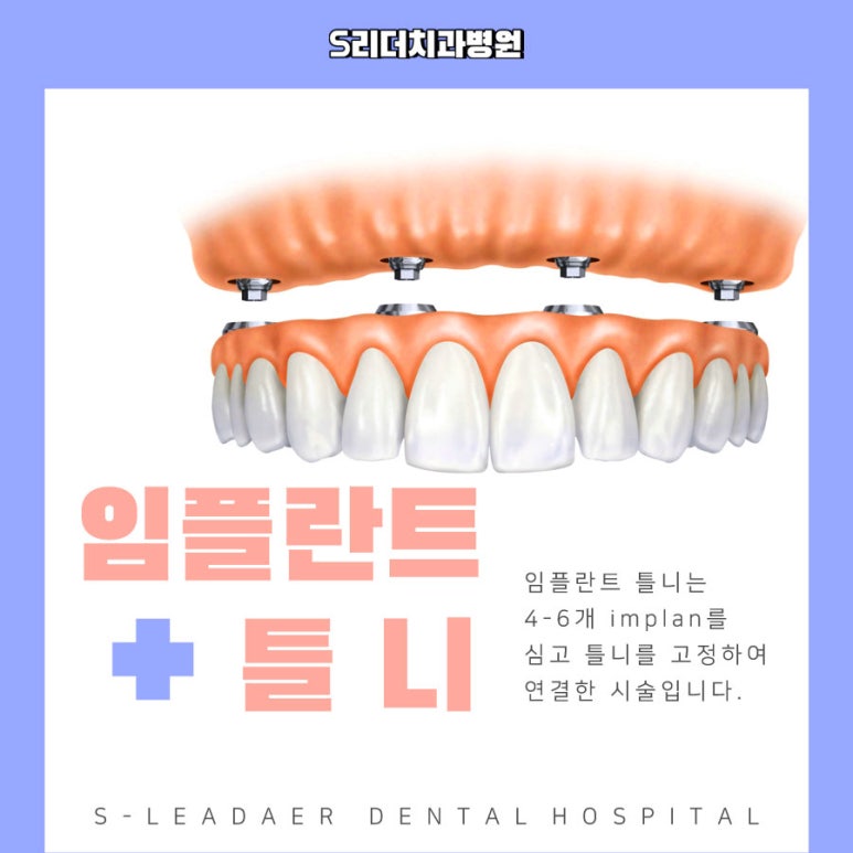 화양동치과 무치악임플란트 보철식립방안 2가지에 대해서 관련 이미지 5