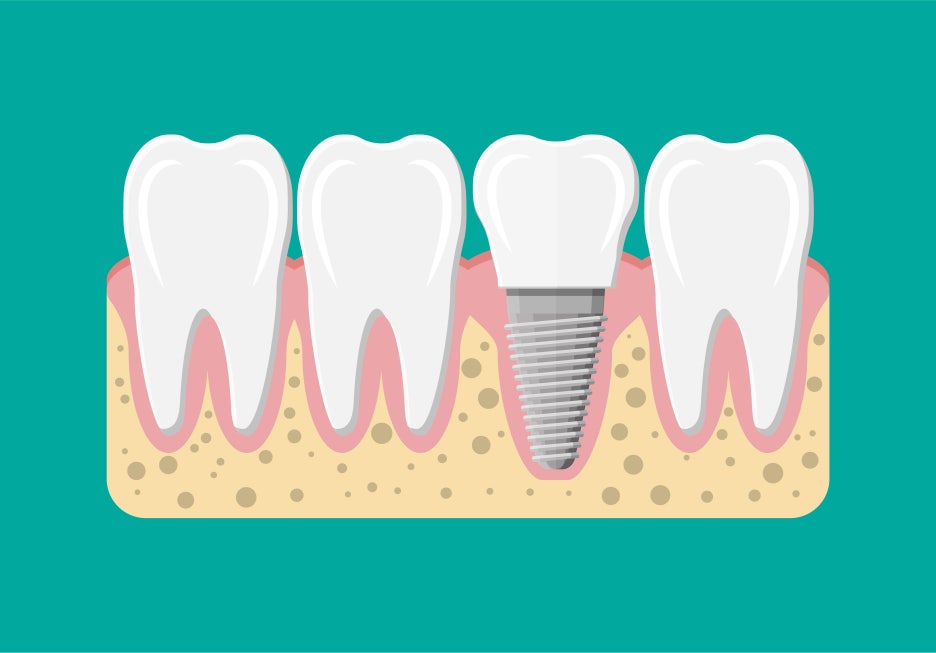 Three Smart Ways to Choose a Dental Clinic for Implant Treatment in Seoul image 3