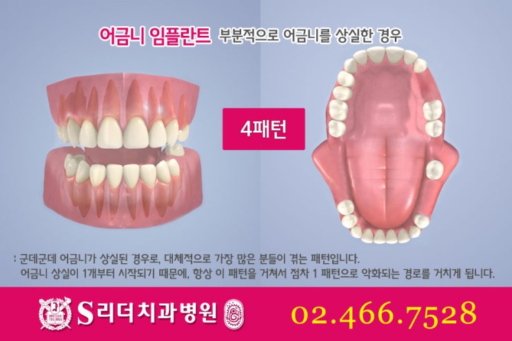 어금니임플란트 알면 좋은정보! 관련 이미지 7