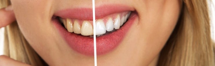 자양동치과잘하는곳 미백치약과 일반치약의 차이점 관련 이미지 2