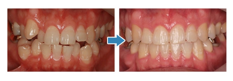 Junggok-dong Dental Clinic: Is the Pain Felt During Orthodontic Treatment Within the Normal Range? image 7