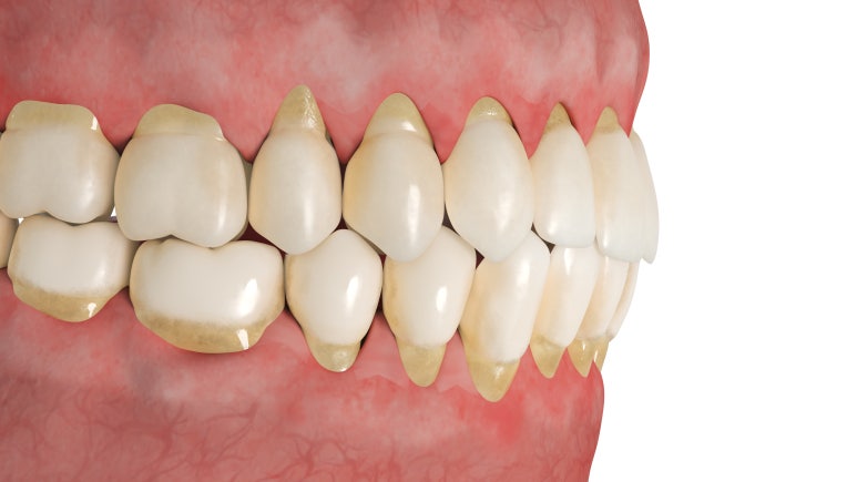 Nungdong Dental Clinic: The Real Reasons Periodontitis Is Progressing Faster in People in Their 20s and 30s, and How to Manage It image 2