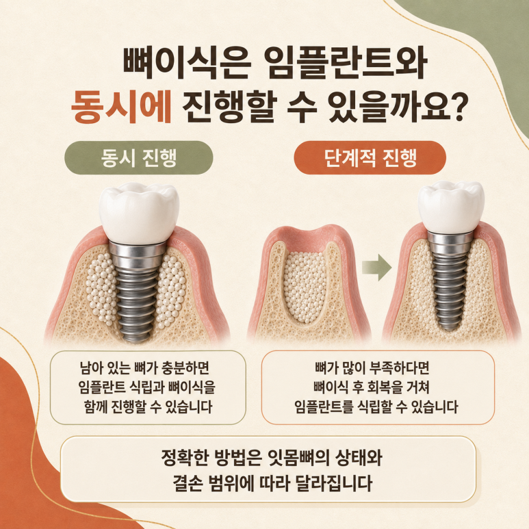 구의동임플란트 뼈이식은 어떤 경우에 필요할까요? 관련 이미지 4