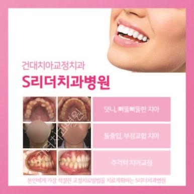 Sagajeong Station Dental Clinic: Why Do Prices Differ by Orthodontic Appliance? image 9