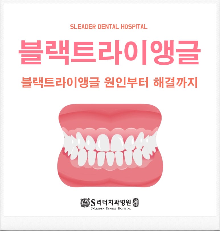 면목역치과, 웃을 때 보이는 삼각형 틈? 블랙트라이앵글 원인부터 해결까지 관련 이미지 1