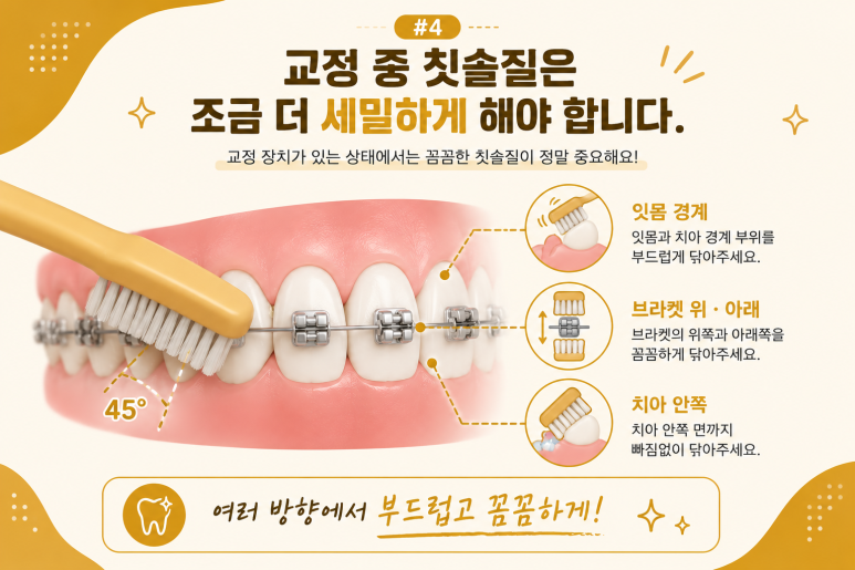 Mangu-dong Dental Clinic: Why Food Keeps Getting Stuck Between Your Teeth During Orthodontic Treatment and How to Manage It image 6