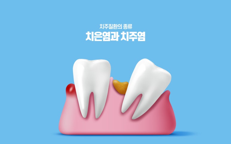 If Your Gums Are Weak, Is Implant or Orthodontic Treatment Possible? Dental Diagnosis Criteria in Dongdaemun-gu image 2