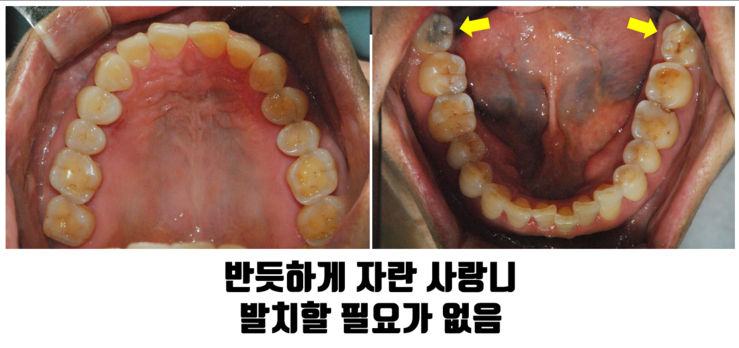 서울치과잘하는곳, 매복 사랑니 vs 단순 사랑니 무엇이 다르고 언제 뽑아야 할까? 관련 이미지 2