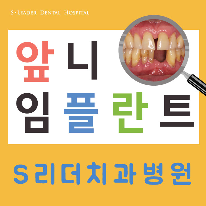 앞니임플란트 몇개를 심어야할까? 관련 이미지 1