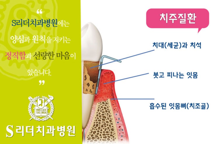 건대치과 치주과 칼럼 : 잇몸약, 제대로 알고 드십니까? 관련 이미지 5