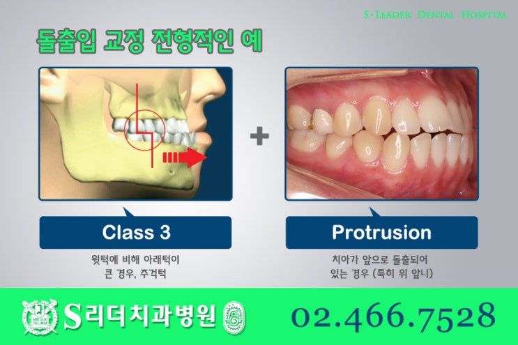 건대교정치과 똑같은 돌출입치아교정이 아니라는 점. 관련 이미지 4