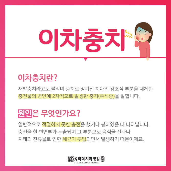 이차충치 이차우식증 원인이 대체 뭐야??? 관련 이미지 2