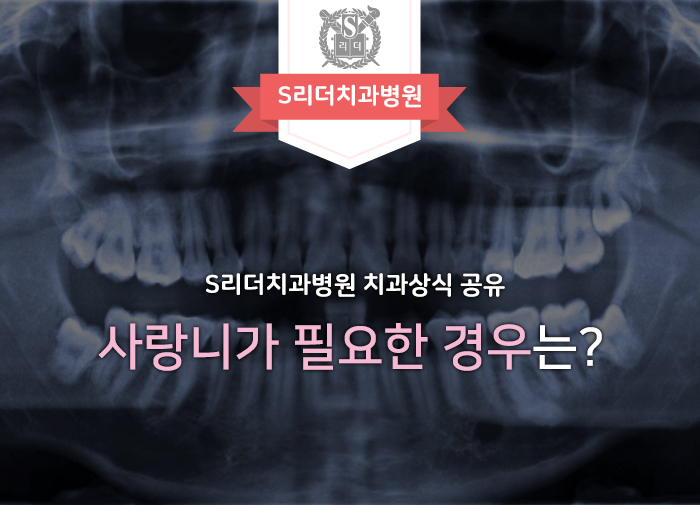사랑니 필요성 사랑니는 쓸모없는 치아가 아니다? 관련 이미지 1