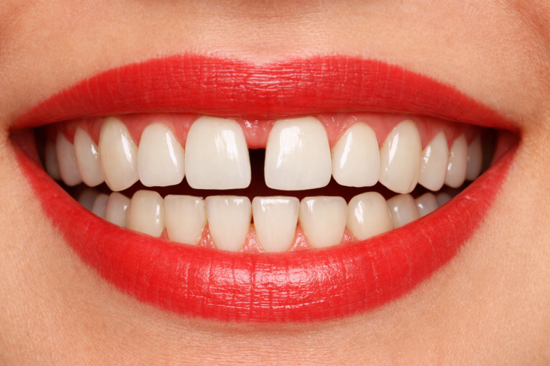 Why Do Teeth Feel Like They’re Spacing Out After Orthodontic Treatment at Nowon Station Dental Clinic? image 3