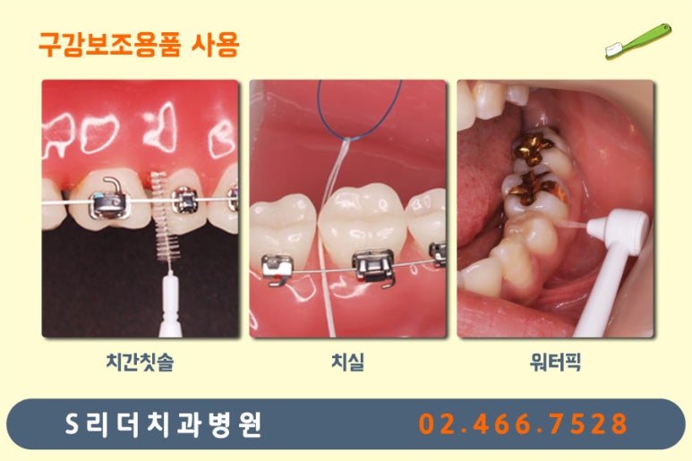 광진구교정치과 치아교정 잘 되기 위한 또하나의 방법? 관련 이미지 7