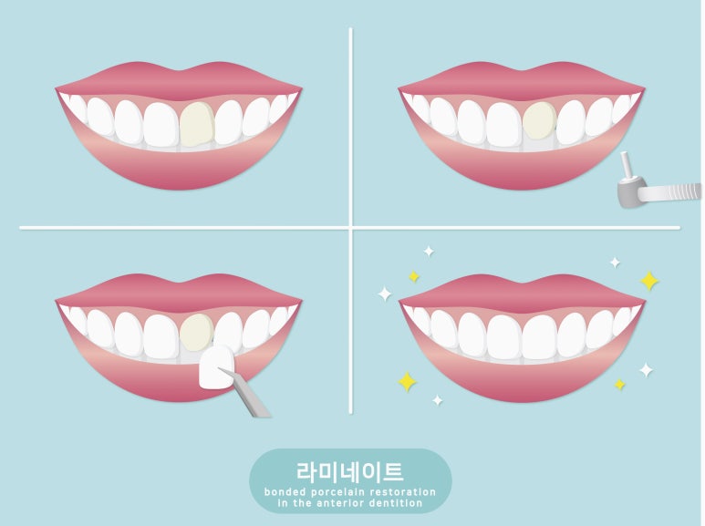 Sagajeong Station Dental Clinic, Make It Even More Perfect with Laminates After Orthodontic Treatment! image 4