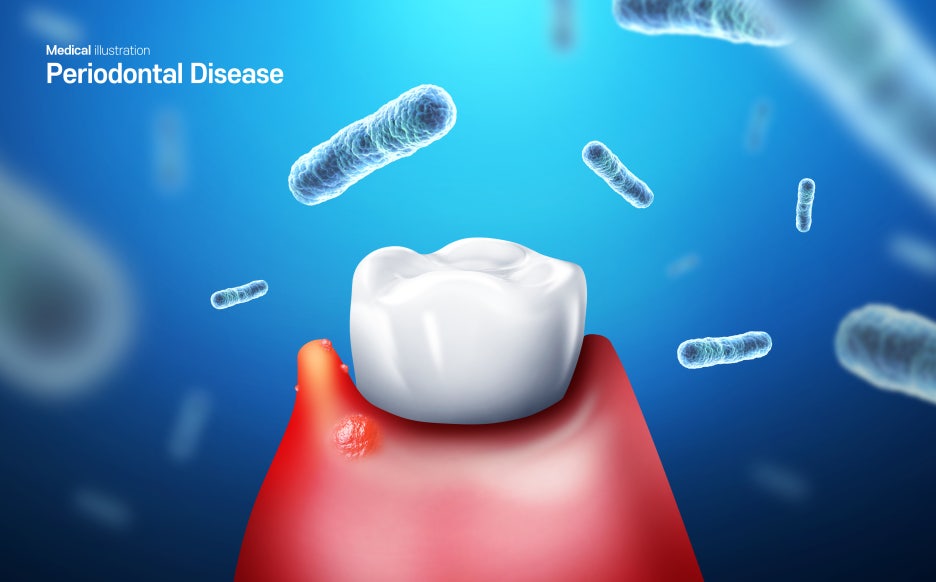 3 Important Things to Note About Chronic and Acute Periodontitis image 2