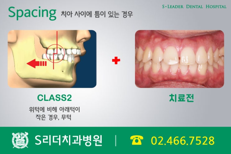 군자동치과에서 치아교정 주인공은 나야나 관련 이미지 5
