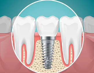 Three Things to Know Before Getting Dental Implants at a Gwangjin-gu Dental Clinic image 7