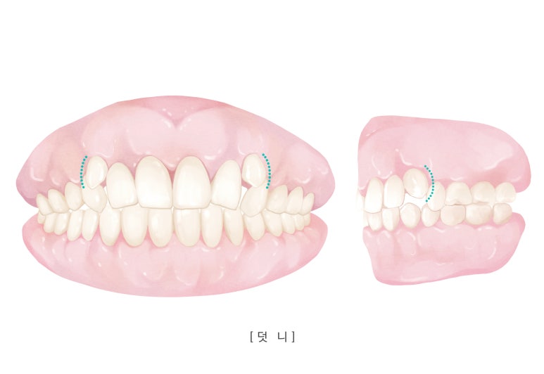 Konkuk Orthodontic Dental Clinic | Why Crowded Canines Occur and When Orthodontic Treatment Is Needed image 5