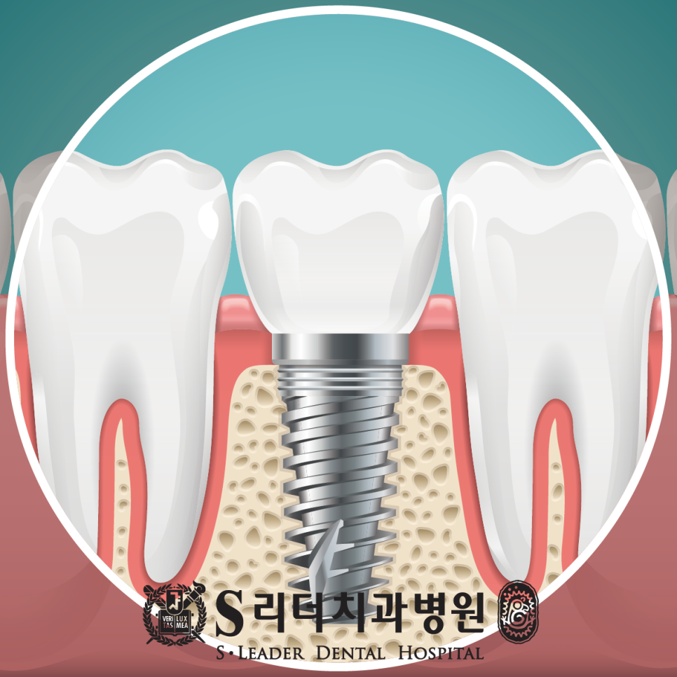 광진구 자양동치과 원데이임플란트의 양면성에 대해 알고 관련 이미지 2
