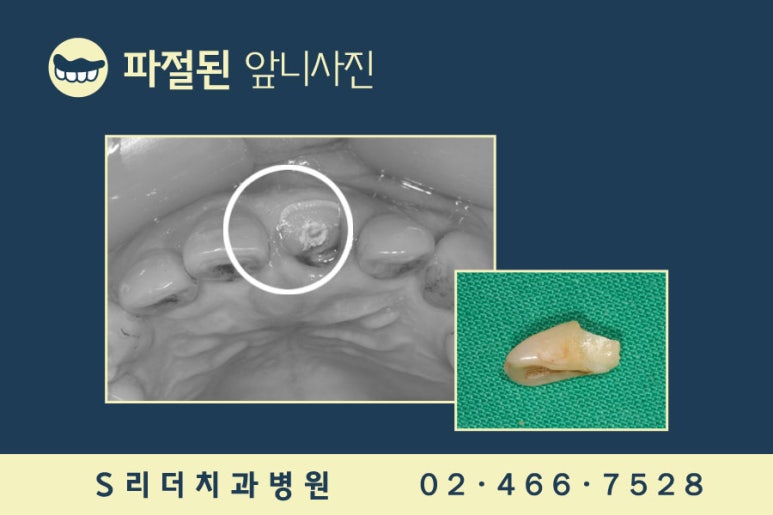 앞니임플란트 2개로 6개치아 완성 관련 이미지 5