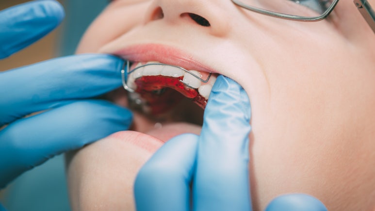 Junggok-dong Dental Clinic: Do You Have to Wear a Retainer for Life After Orthodontic Treatment? A Complete Guide to Retainer Duration image 5