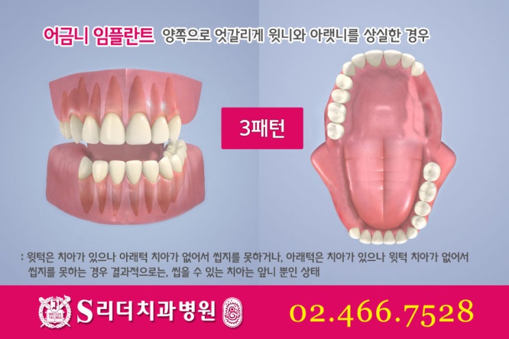 어금니임플란트 알면 좋은정보! 관련 이미지 6