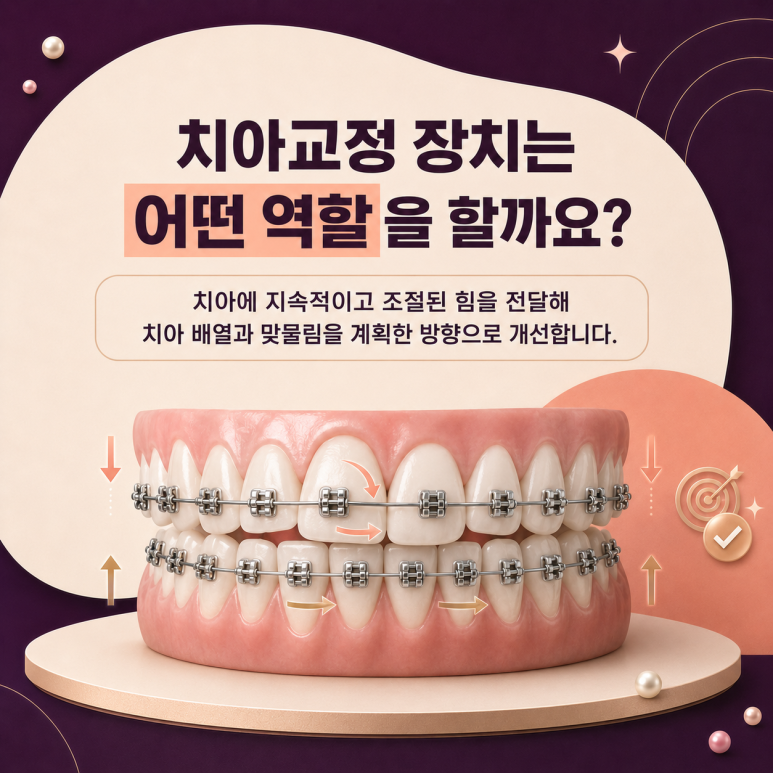 군자치과, 치아교정 장치는 어떤 게 좋을까요? 교정 장치 종류 알아보기 관련 이미지 2