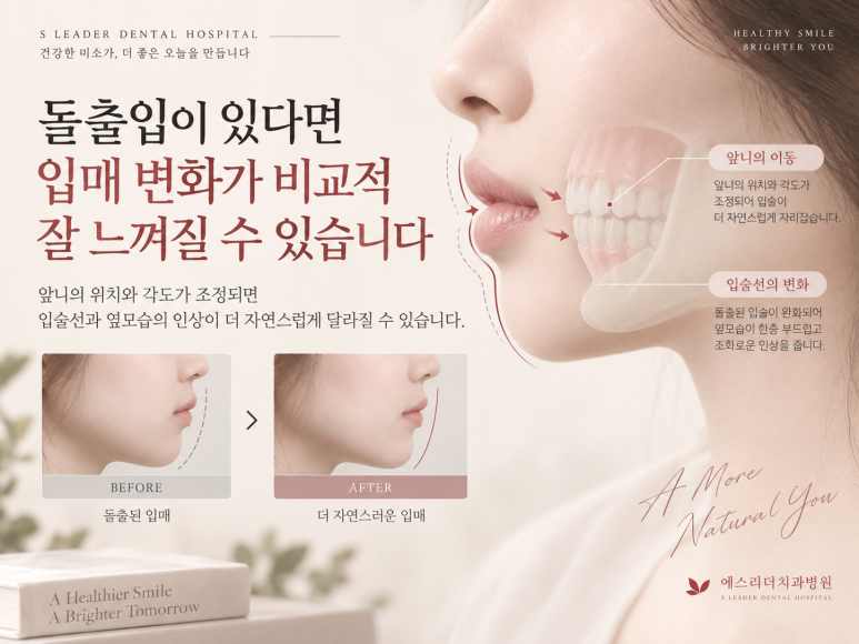 건대교정치과, 교정하면 얼굴형이 정말 달라질까요? 관련 이미지 3