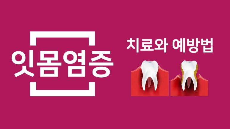 건대입구치과 | 잇몸병은 왜 조용히 진행될까? 초기 신호 체크리스트 10가지 관련 이미지 7