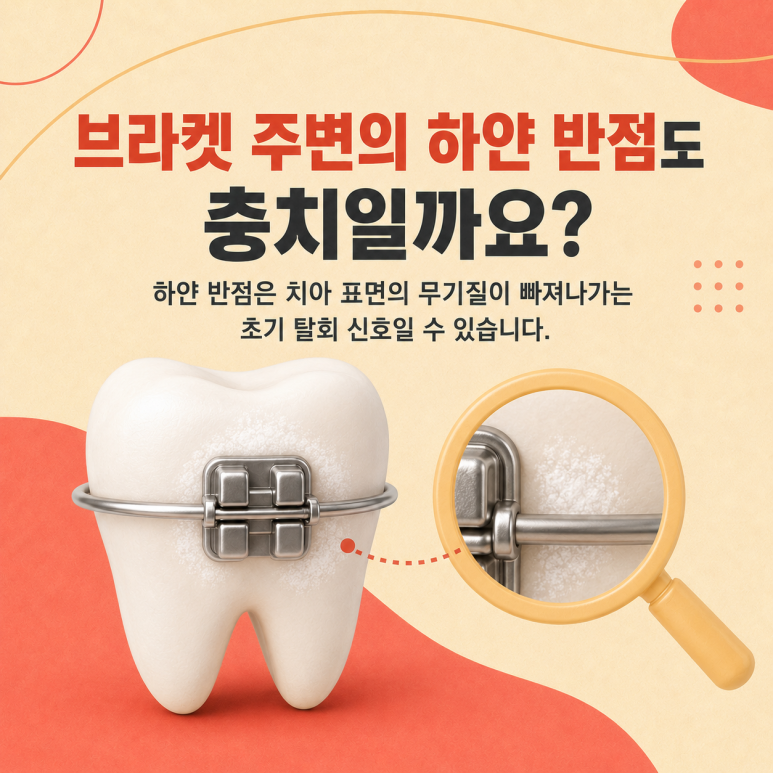 건대교정치과, 교정 장치 주변에는 왜 충치가 생기기 쉬울까요? 예방법까지 관련 이미지 4