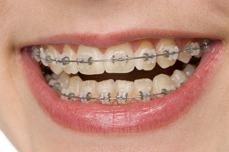 Seoul Night Dental | Clear Aligners vs. Traditional Braces: Which Is Right for Me? From Differences to Selection Criteria image 4