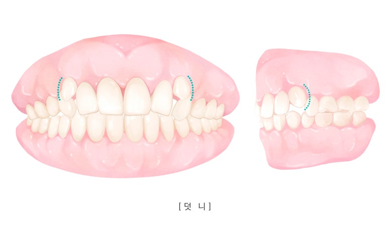 용마산역치과, 덧니 주걱턱 치아교정 개선하기 위한 과정은 관련 이미지 3