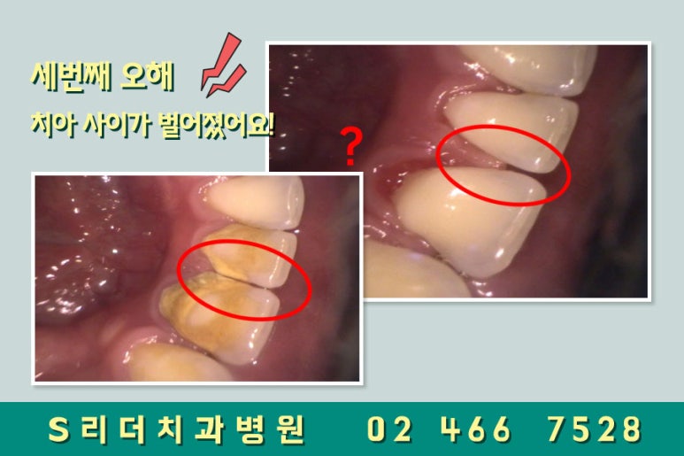 광진구치과 스케일링 오해하지마세요~ 관련 이미지 4