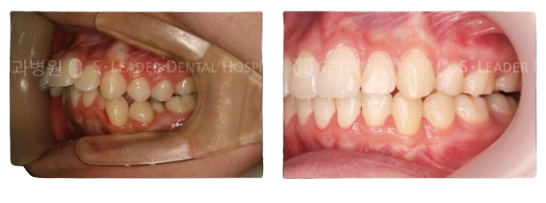 [Achasan Station Orthodontics] How to Correct Bunny Teeth While Addressing Both Aesthetics and Function image 5