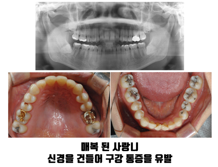 구의동치과, 사랑니 발치 후 회복 기간이 달라지는 이유 관련 이미지 3