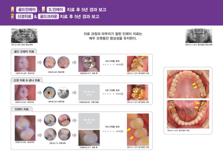 건대입구역치과 병원의 인레이 충치치료후 5년이상 경과한 치료증례 비교 관련 이미지 1