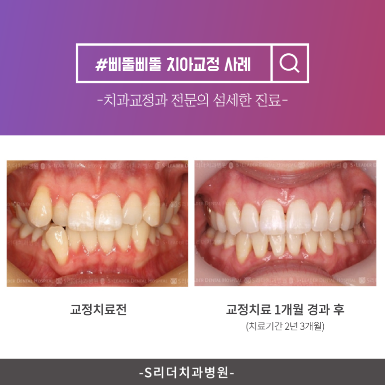 자양역치아교정, 교정 중 충치가 더 잘 생기는 이유 관련 이미지 8