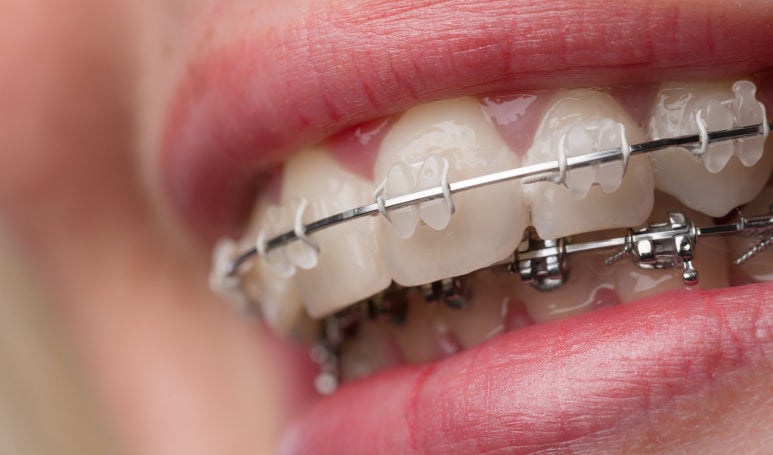 Gwangjin-gu Orthodontic Clinic: Why Do Orthodontic Treatment Periods Differ? Checkpoints That Determine Treatment Speed image 7