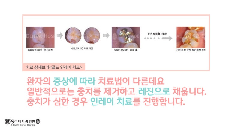 Konkuk University Dental Clinic Cavity Treatment by Stage｜A Clear Summary from Early Stage to Root Canal Treatment image 4