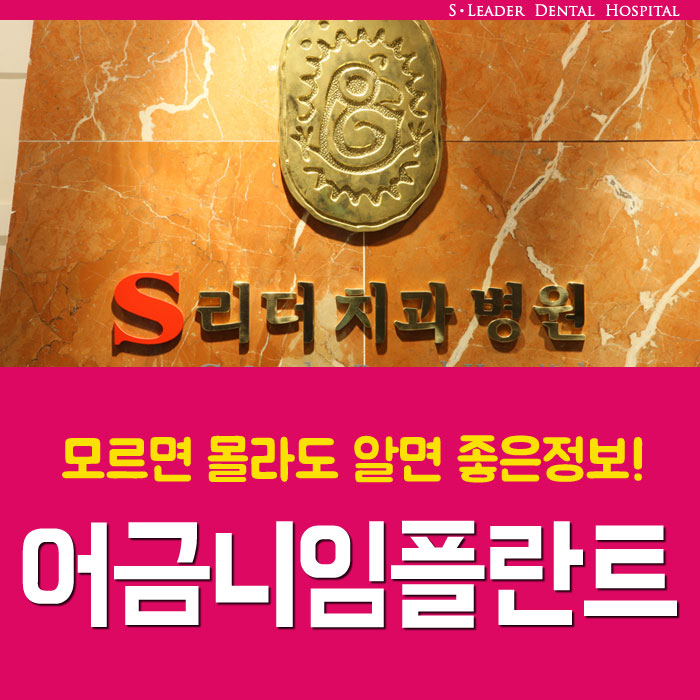 어금니임플란트 알면 좋은정보! 관련 이미지 1