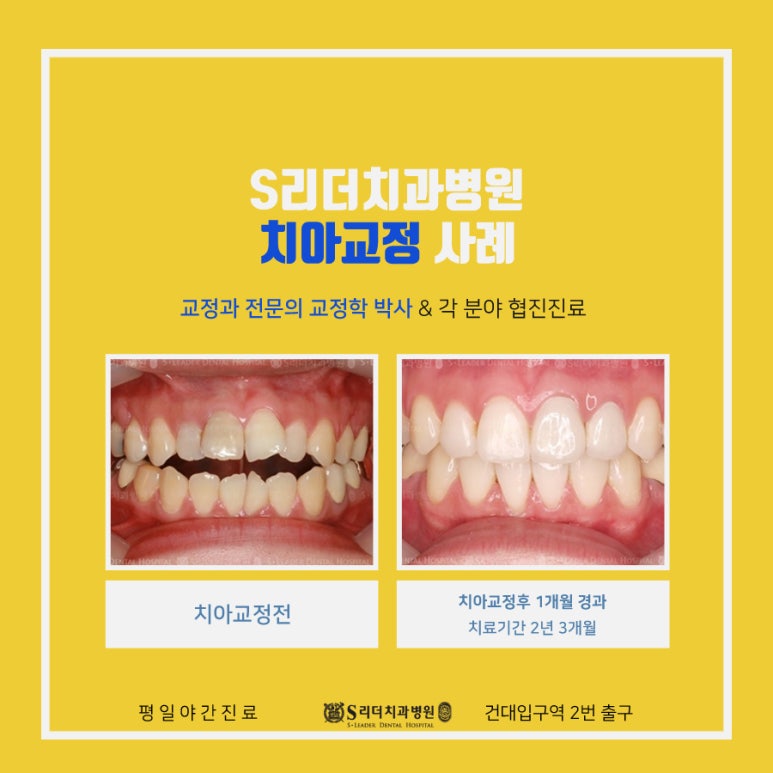 광진구치아교정, 주걱턱교정 어떻게 진행될까? 관련 이미지 8