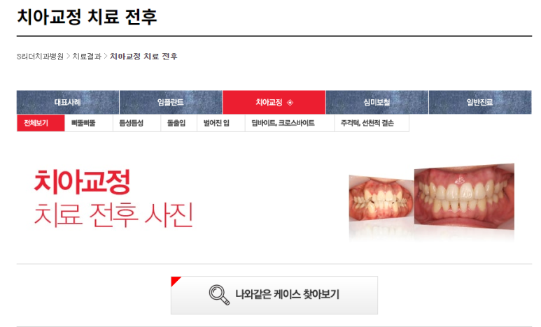 서울치아교정잘하는곳 어린이부정교합 교정시기가 궁금하다면 관련 이미지 4