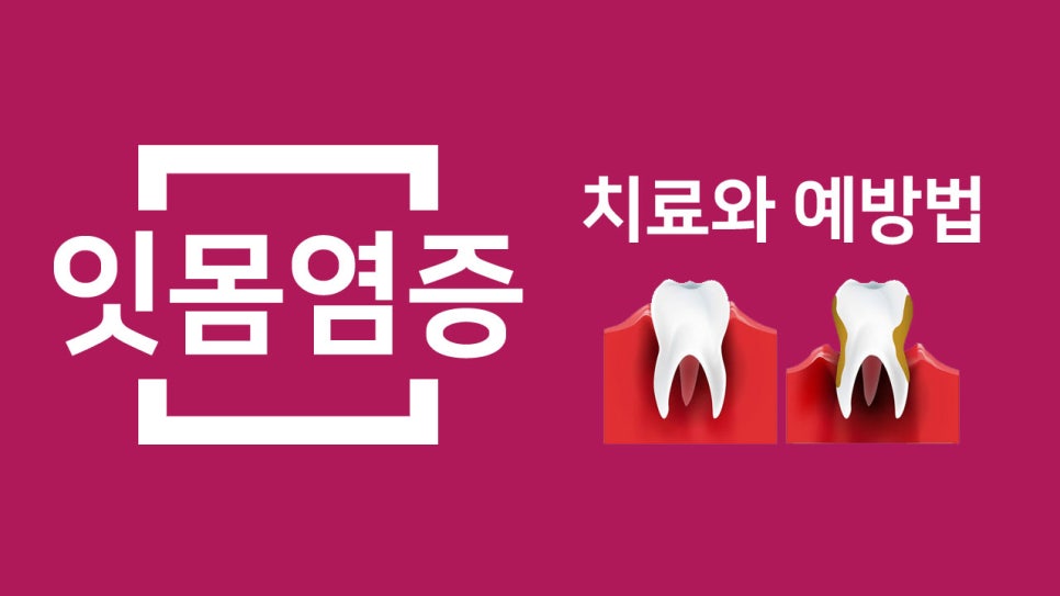 면목동치과 소아청소년 스케일링, 치주질환유병률에 대해 관련 이미지 5