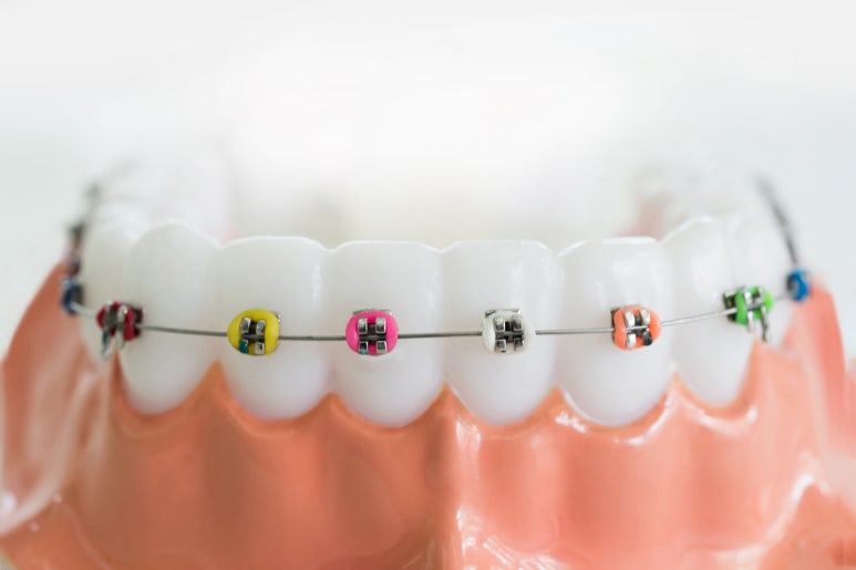 Jungnang-gu Orthodontic Clinic: Can protruding buck teeth be corrected with partial orthodontics? image 3