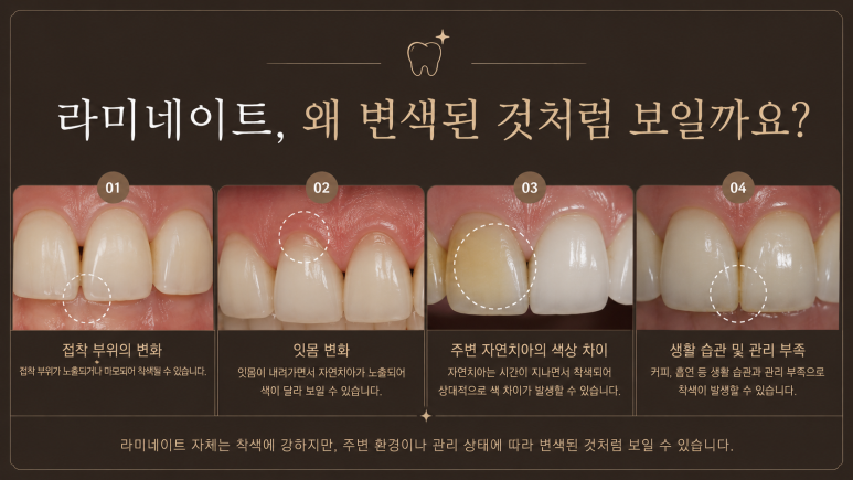 구의동치과|라미네이트 후 착색이 생길 수 있을까요? 관련 이미지 3