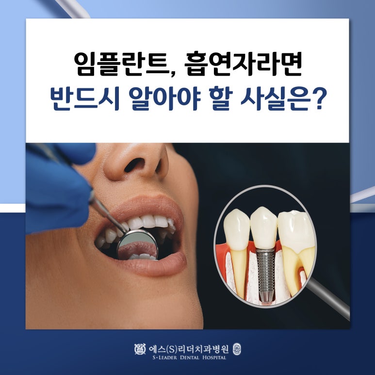 Jungang-dong Dental Implants: If You Smoke, Start Preparing in Advance image 1