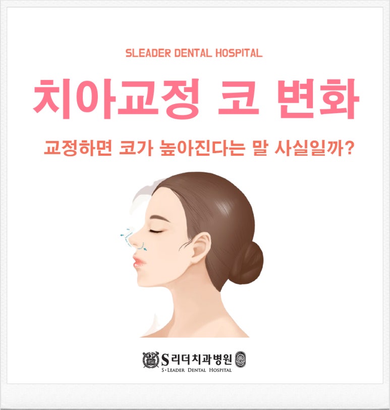 Konkuk University Dental Hospital: Is It True That Orthodontics Makes the Nose Look Higher? image 1